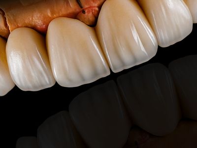 Veneer Work